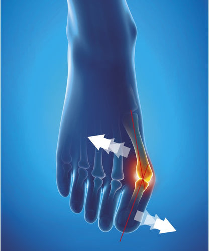 EPITACT ORTESI CORRETTIVA ALLUCE DA GIORNO